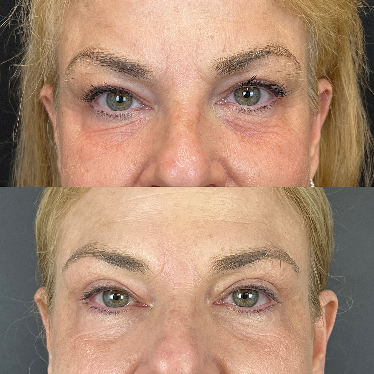 Upper  Blepharoplasty Before & After