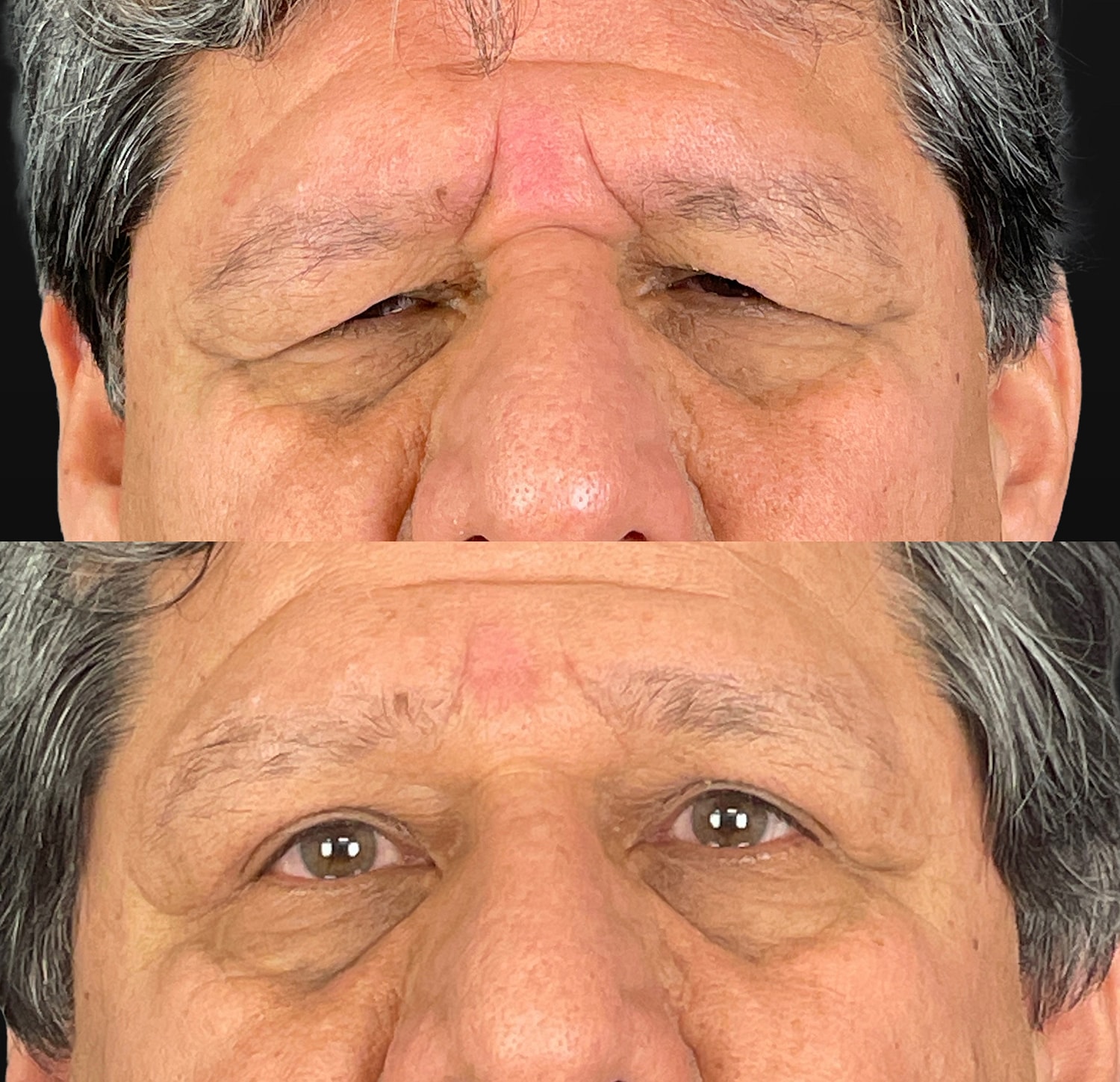 Brow Lift Before & After