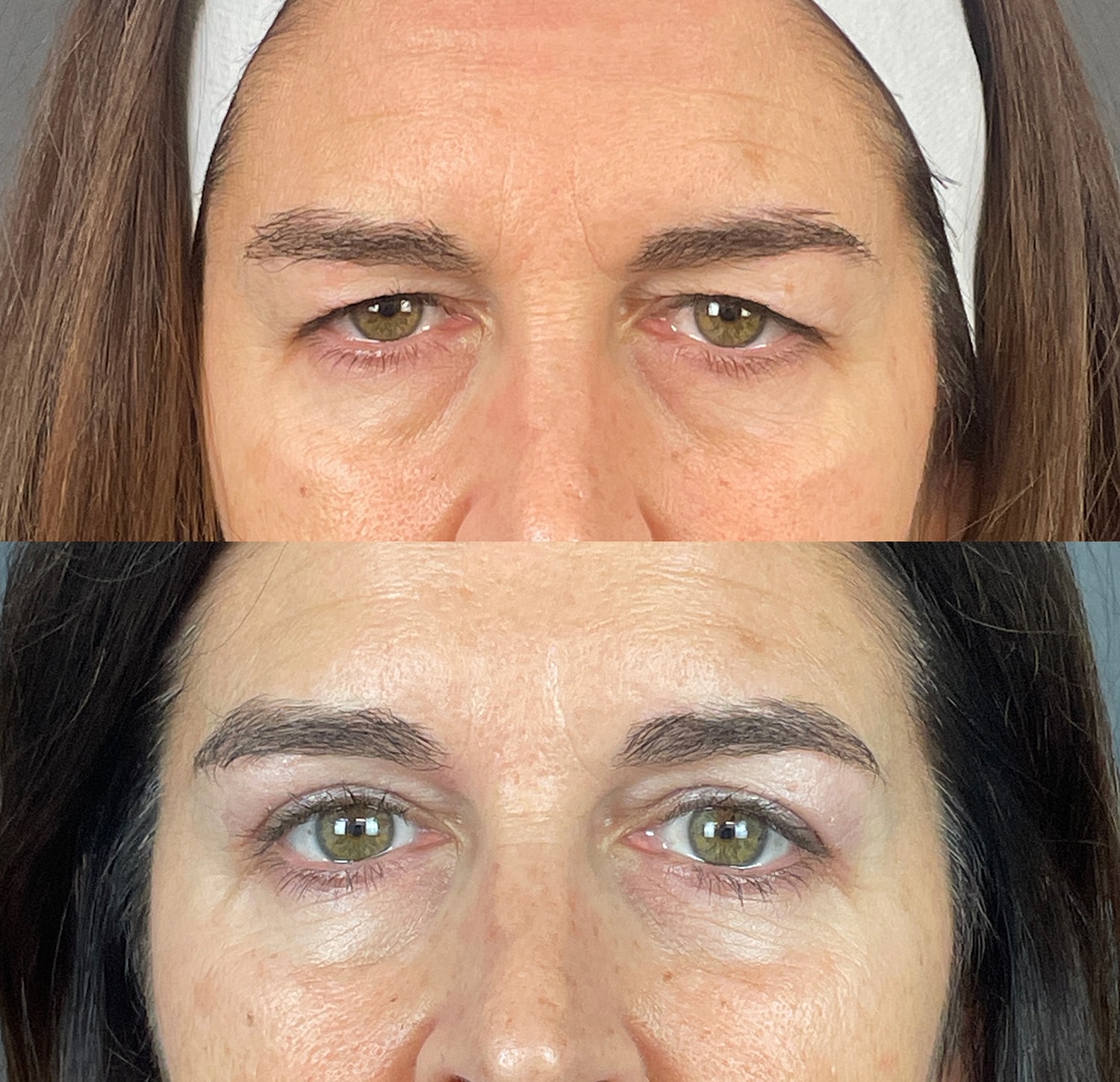 Brow Lift Before & After
