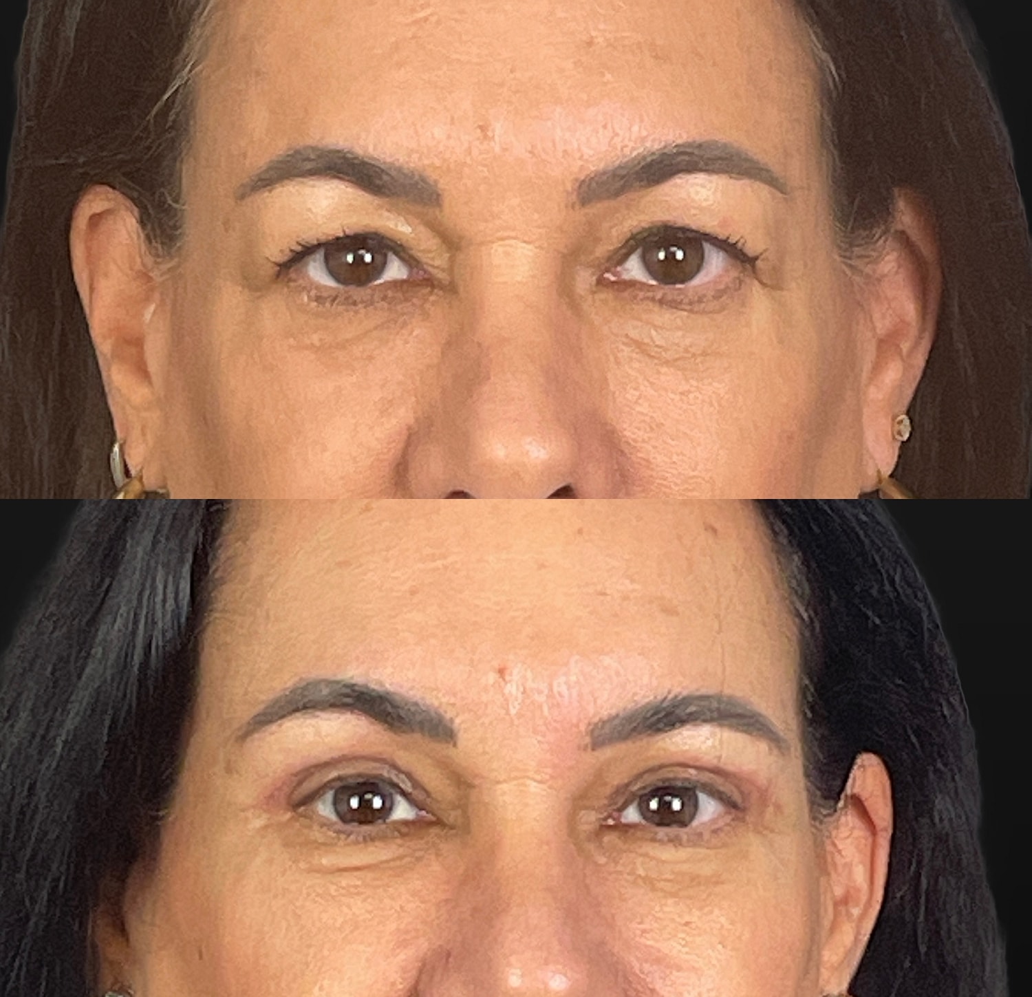 Brow Lift Before & After