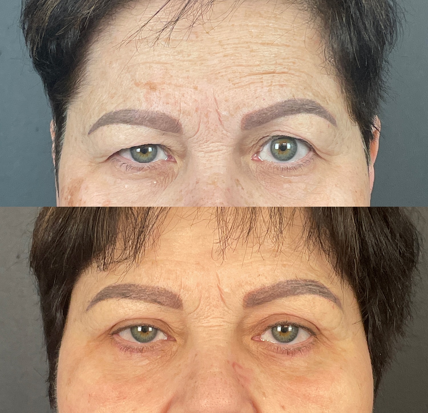 Brow Lift Before & After
