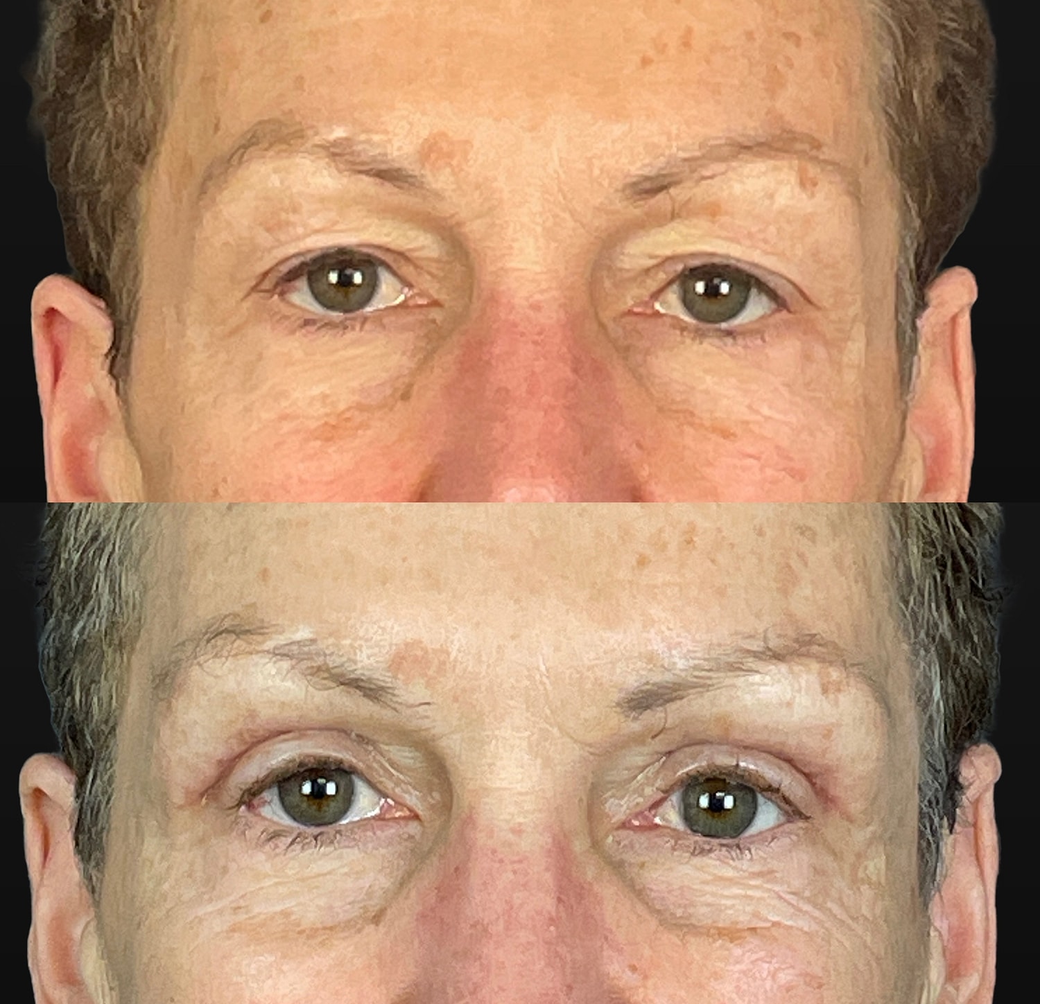 Brow Lift Before & After