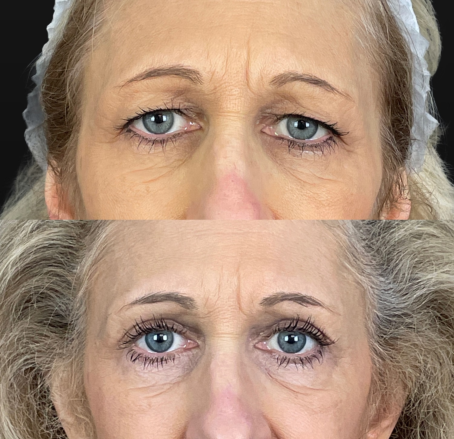 Brow Lift Before & After
