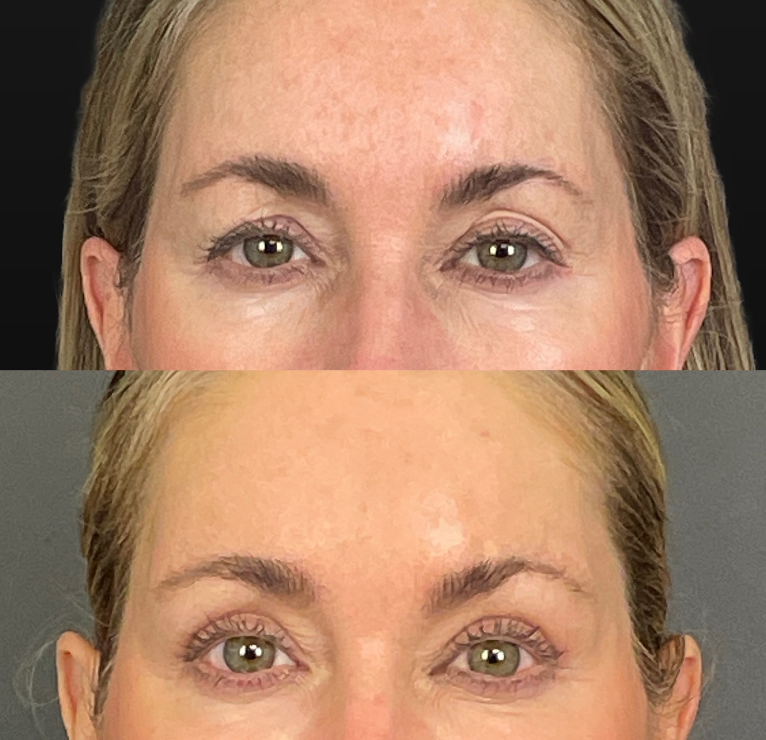 Brow Lift Before & After