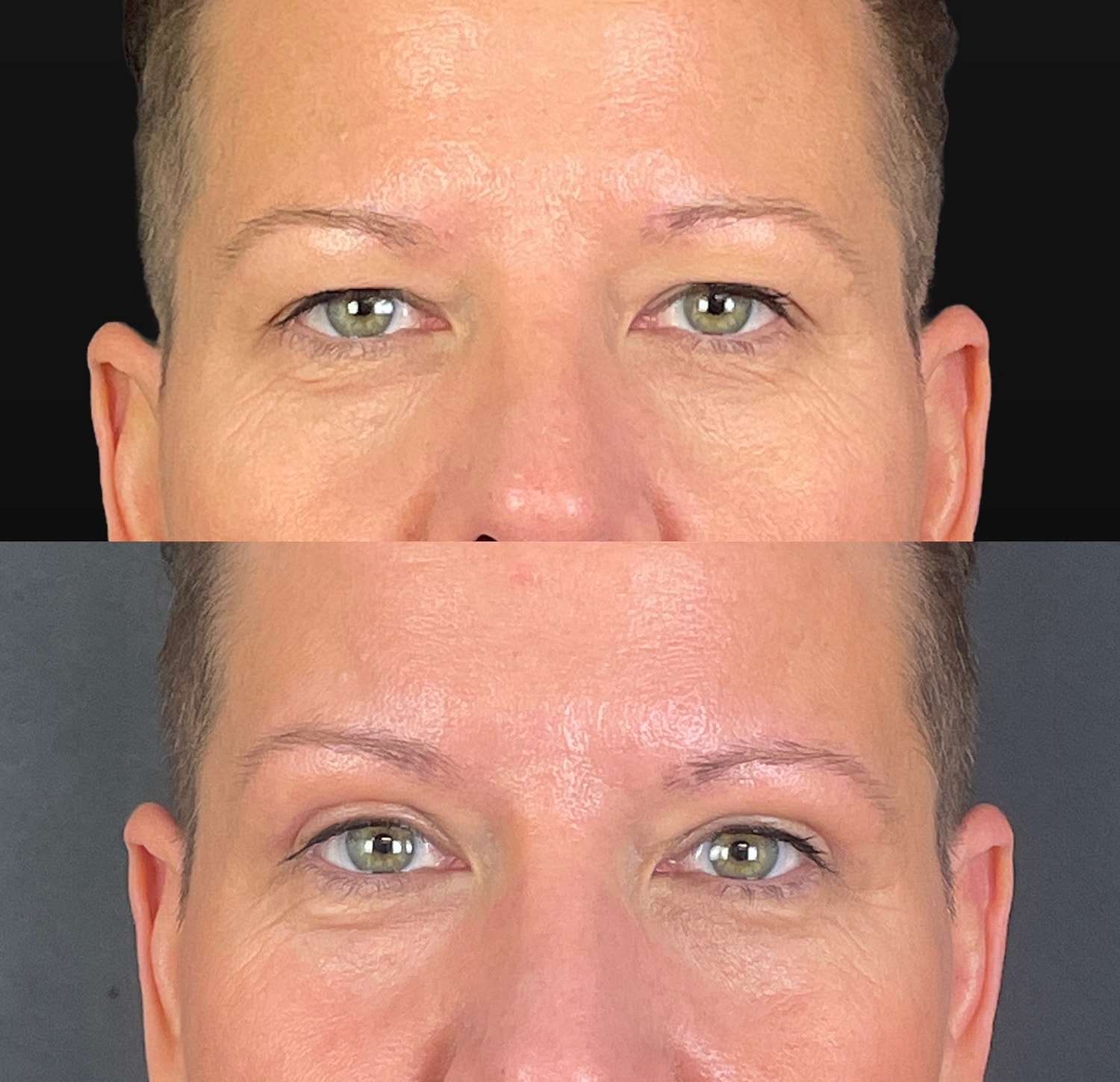 Brow Lift Before & After