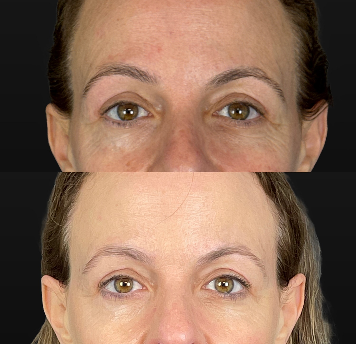 Brow Lift Before & After