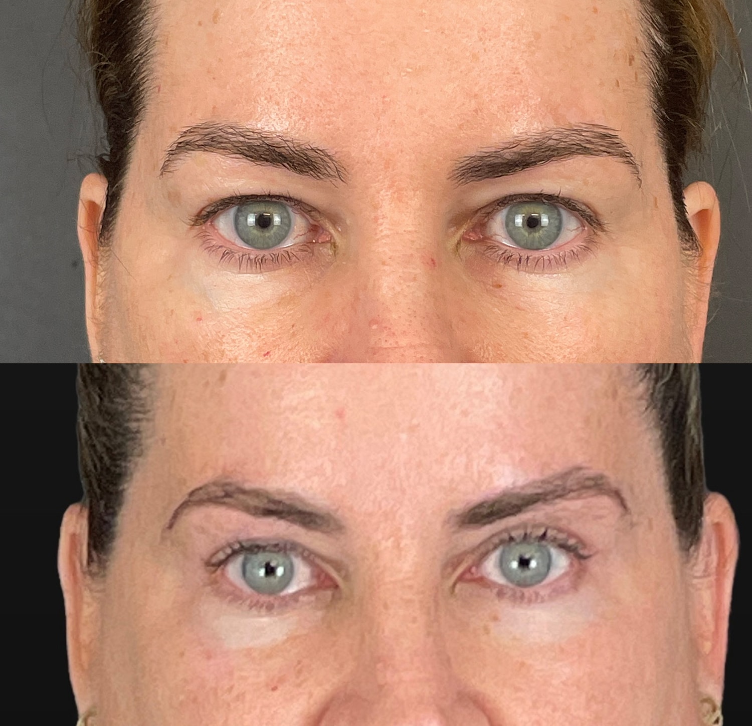 Brow Lift Before & After