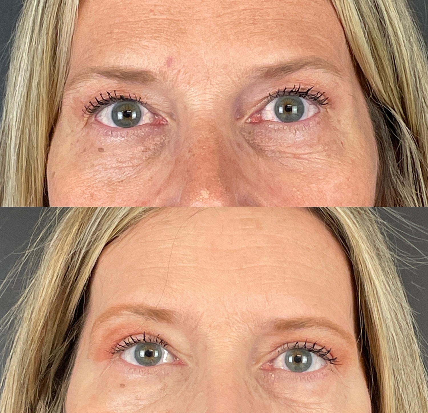 Brow Lift Before & After