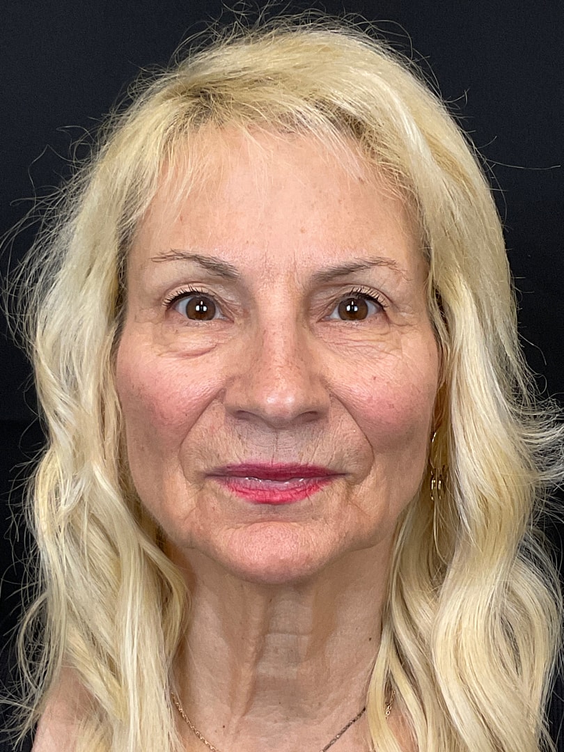 Brow Lift Before & After