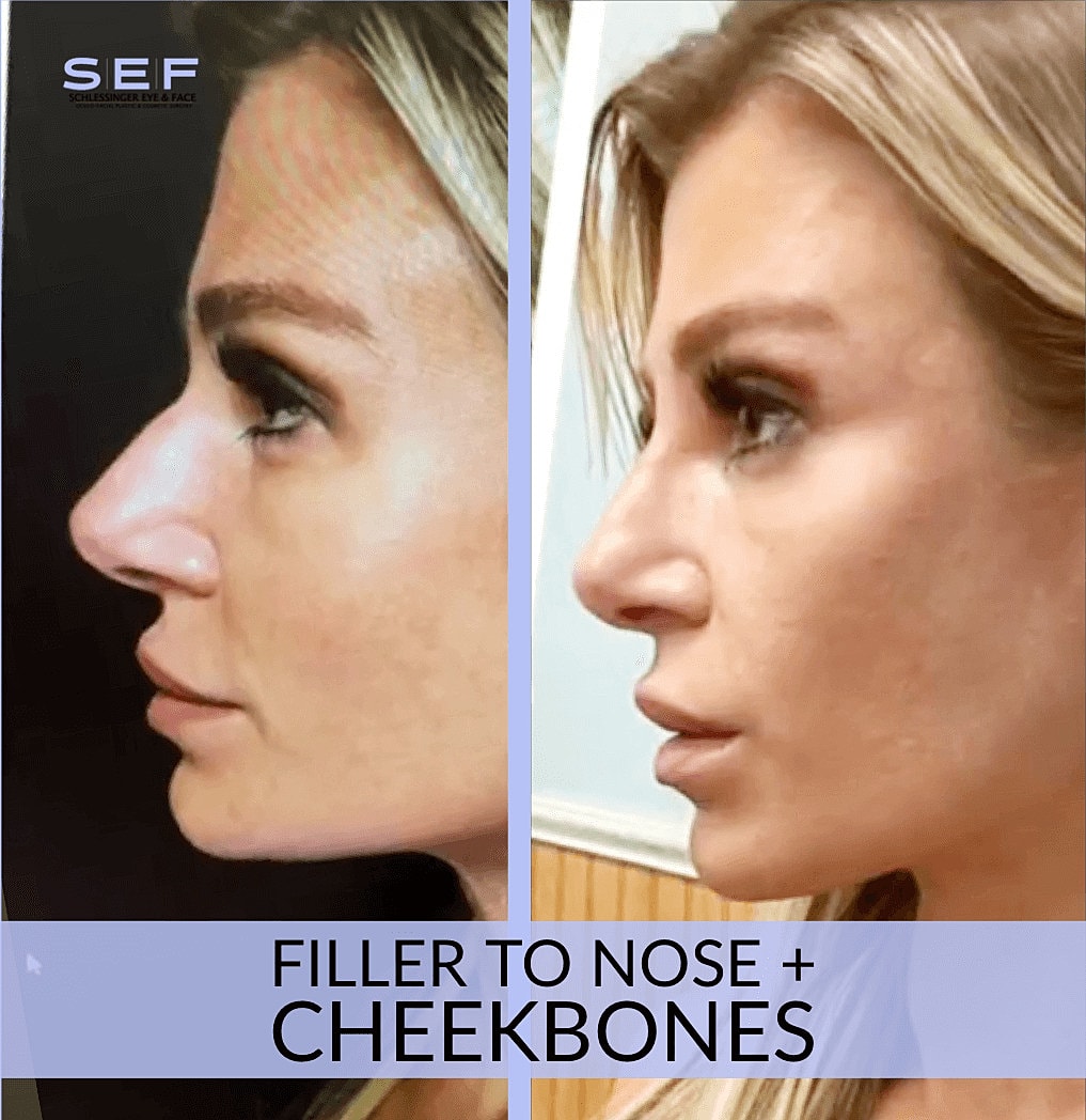 Dermal Fillers Before & After