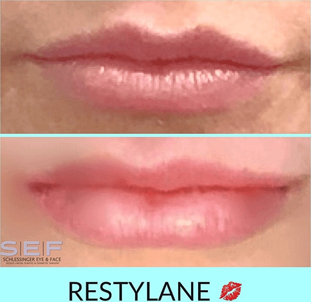 Dermal Fillers Before & After
