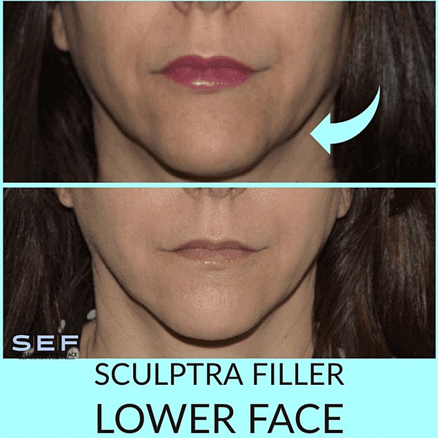 Dermal Fillers Before & After