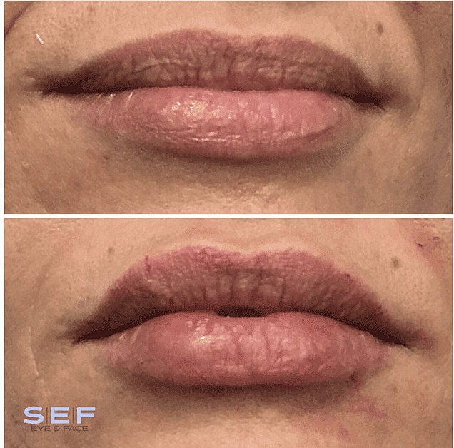 Dermal Fillers Before & After