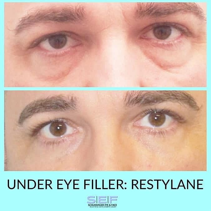 Dermal Fillers Before & After
