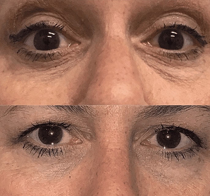 Dermal Fillers Before & After