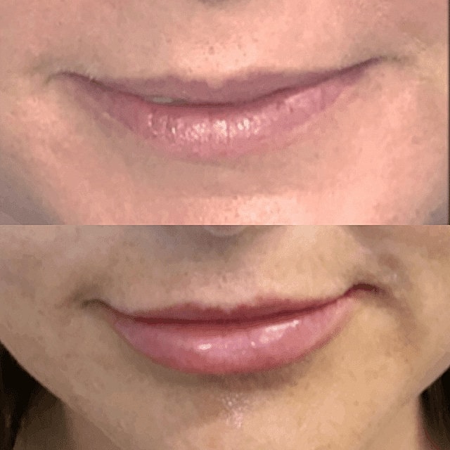 Dermal Fillers Before & After