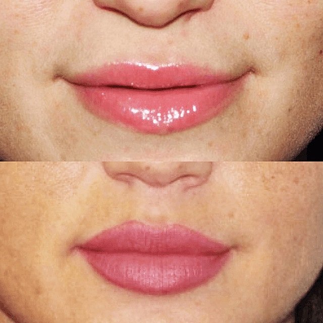 Dermal Fillers Before & After