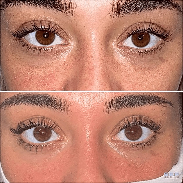 Dermal Fillers Before & After