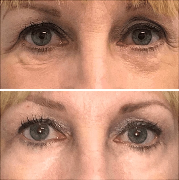 Dermal Fillers Before & After