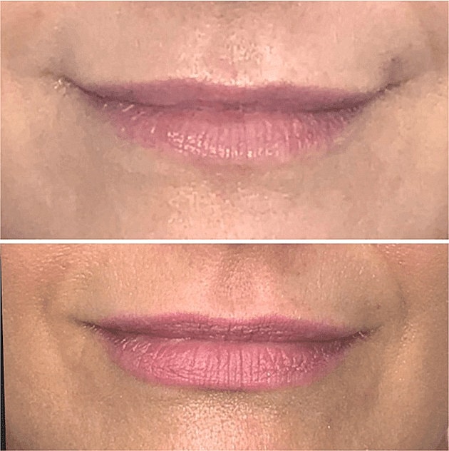 Dermal Fillers Before & After
