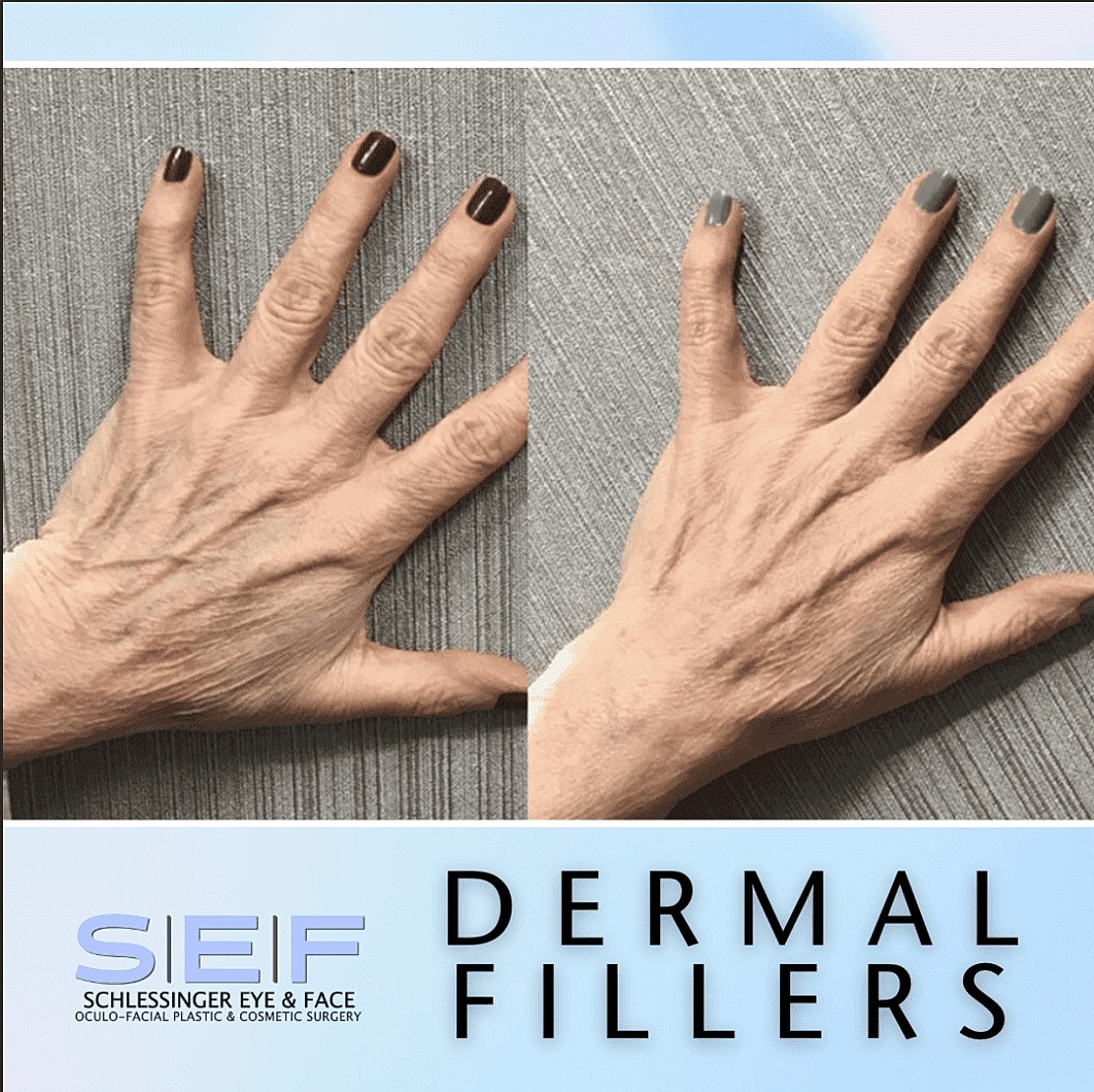 Dermal Fillers Before & After