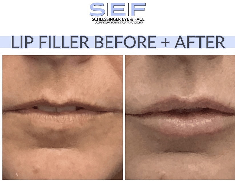 Dermal Fillers Before & After