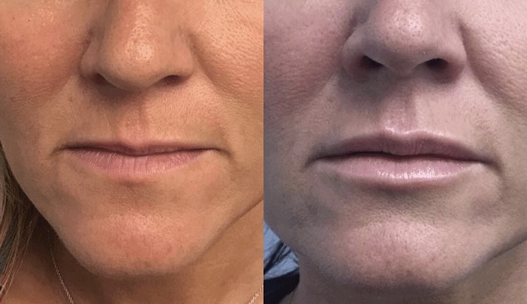 Dermal Fillers Before & After