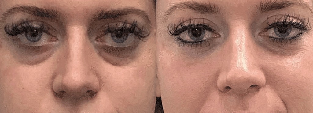 Dermal Fillers Before & After