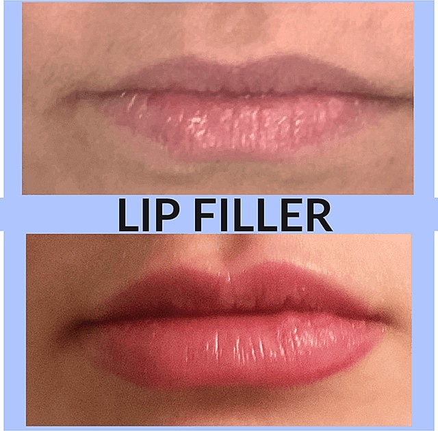 Dermal Fillers Before & After