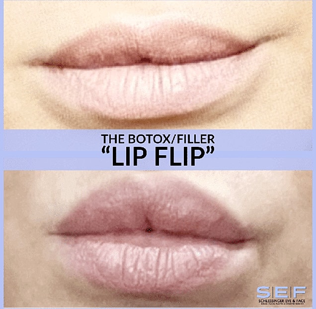Dermal Fillers Before & After