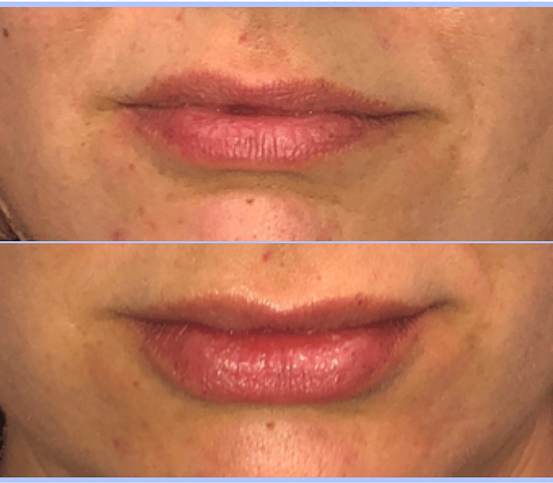 Dermal Fillers Before & After