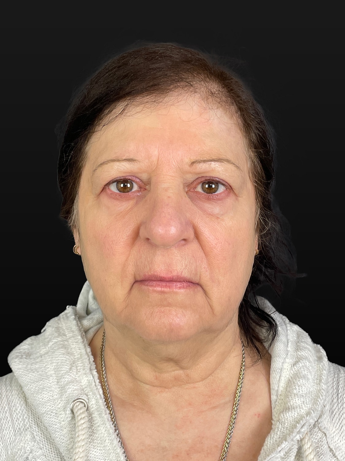 C02 Laser Resurfacing Before & After