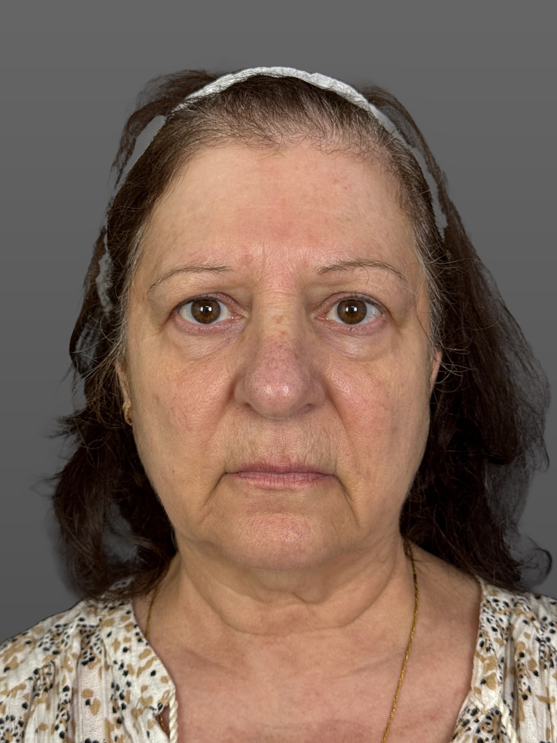 C02 Laser Resurfacing Before & After