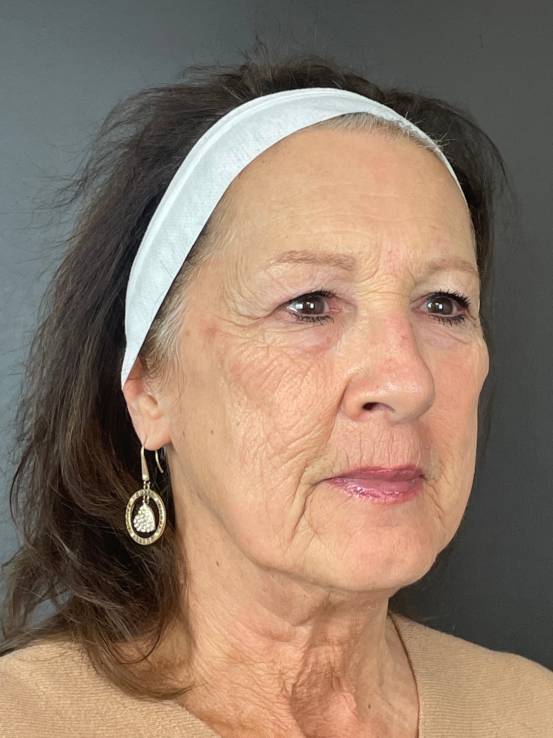 C02 Laser Resurfacing Before & After