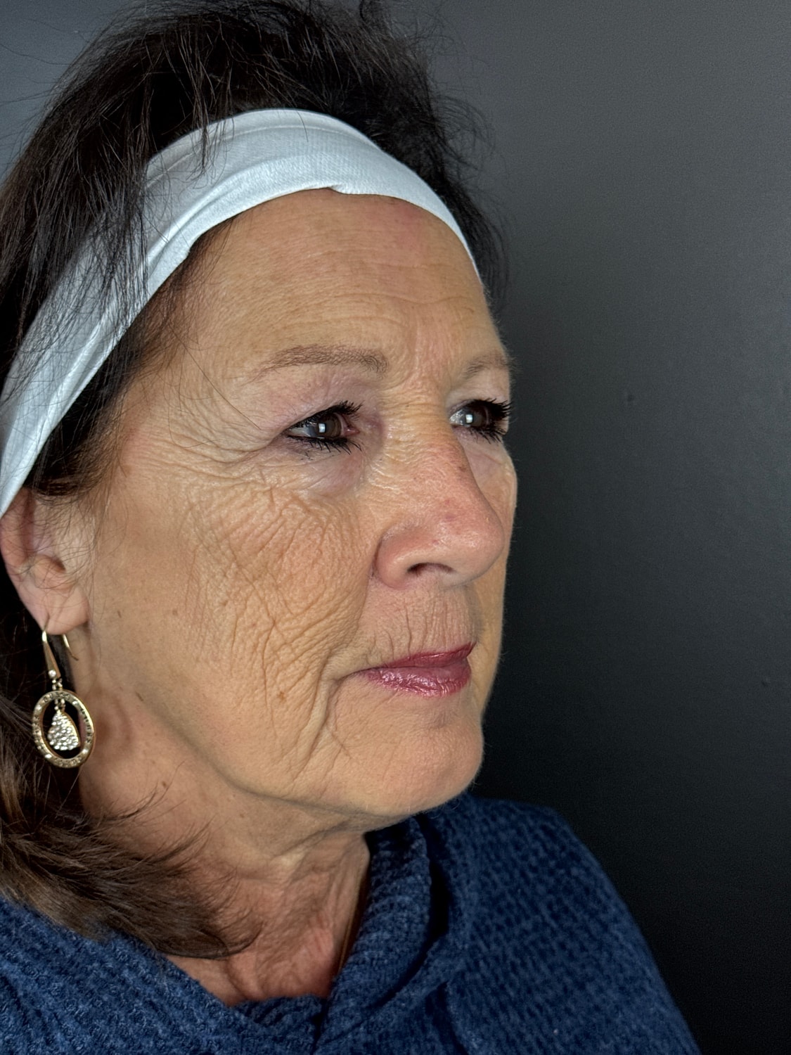 C02 Laser Resurfacing Before & After
