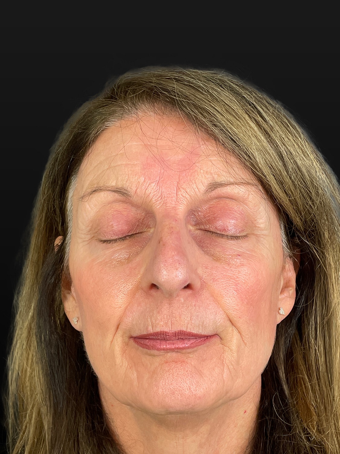 C02 Laser Resurfacing Before & After