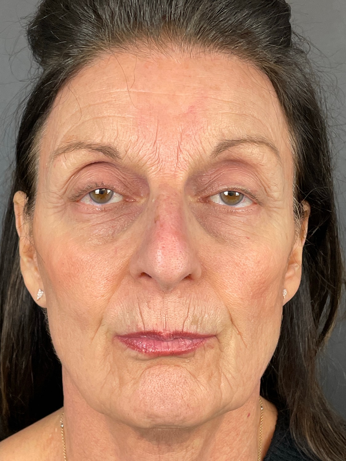 C02 Laser Resurfacing Before & After
