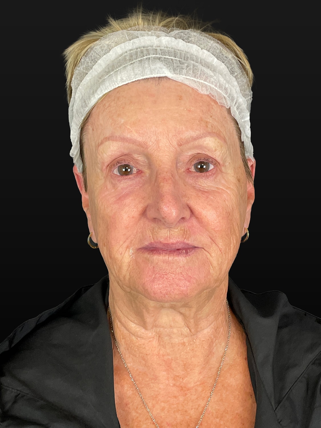 C02 Laser Resurfacing Before & After