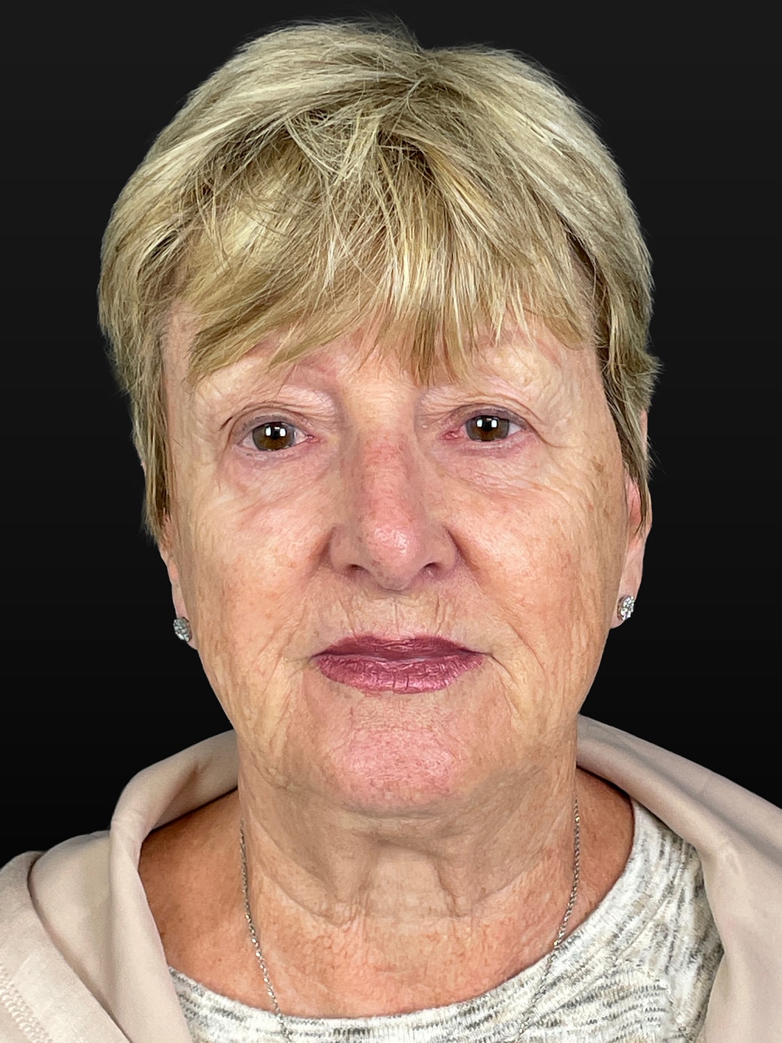 C02 Laser Resurfacing Before & After