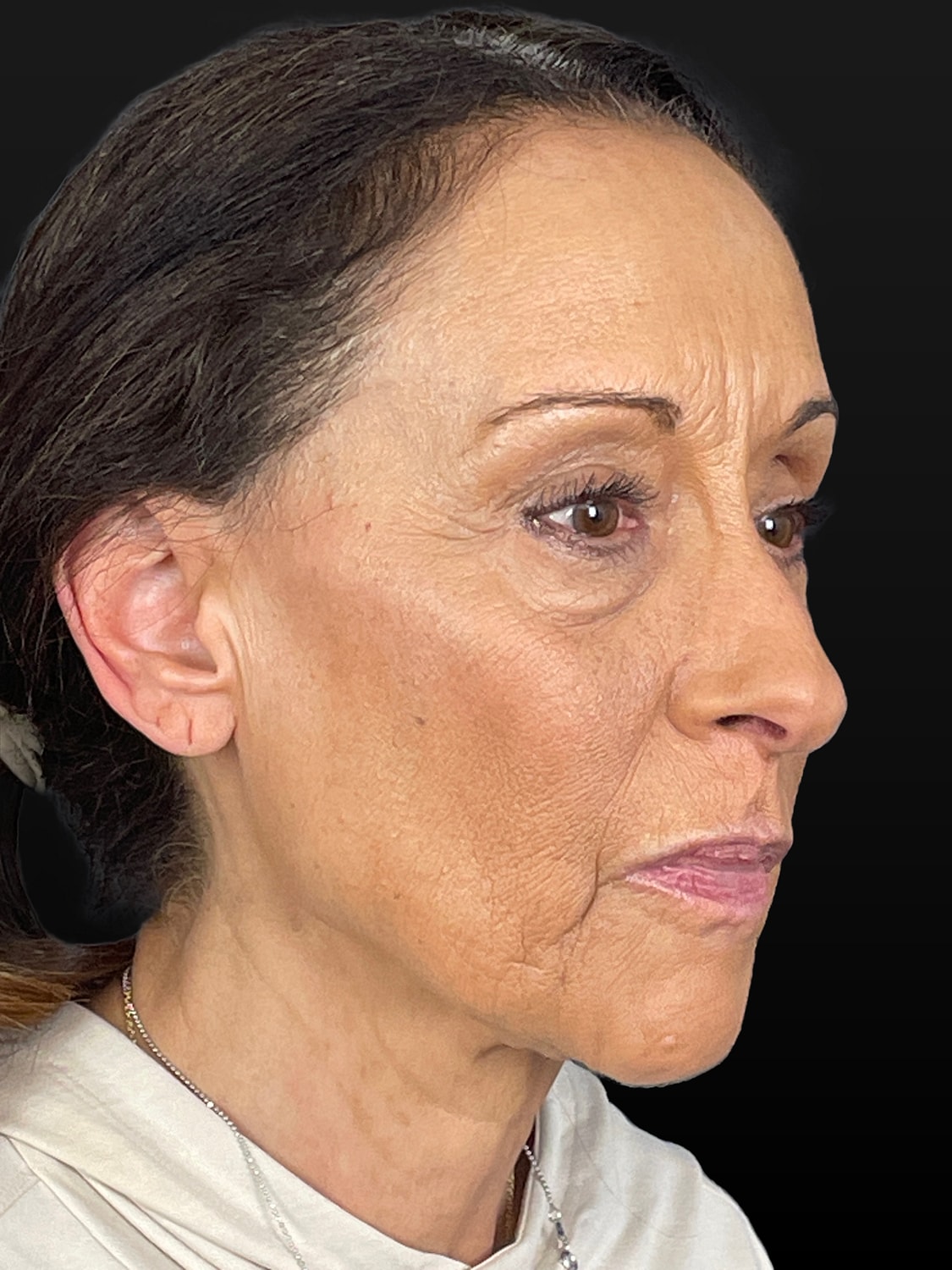 C02 Laser Resurfacing Before & After