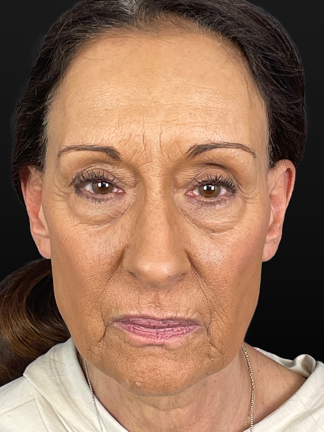 C02 Laser Resurfacing Before & After