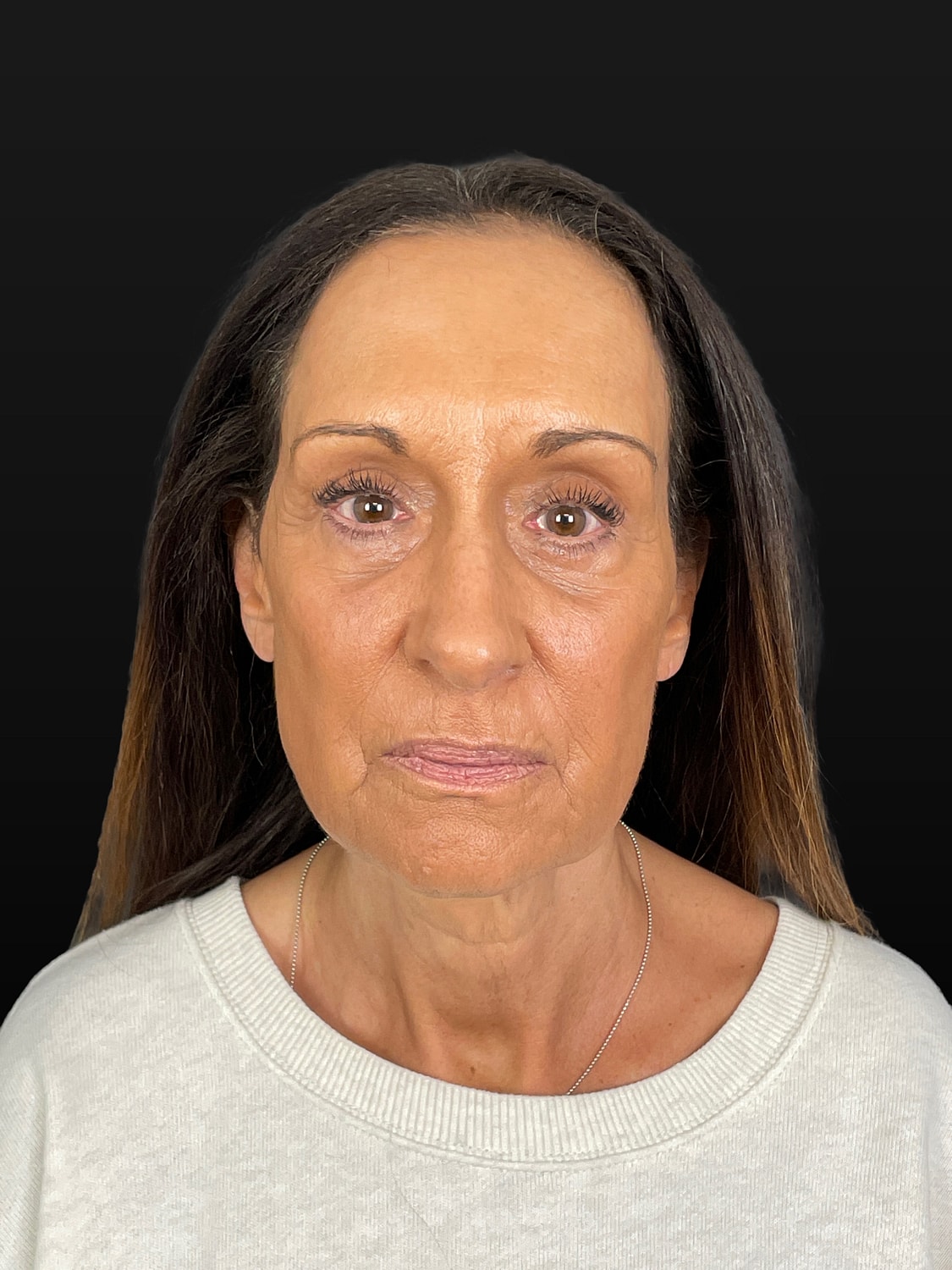 C02 Laser Resurfacing Before & After