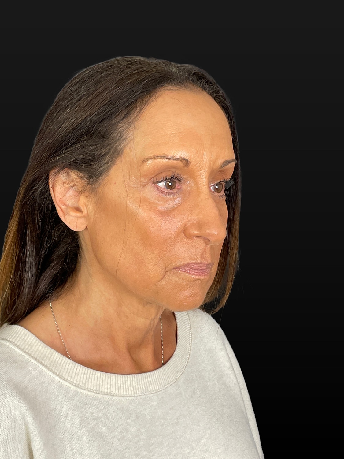 C02 Laser Resurfacing Before & After