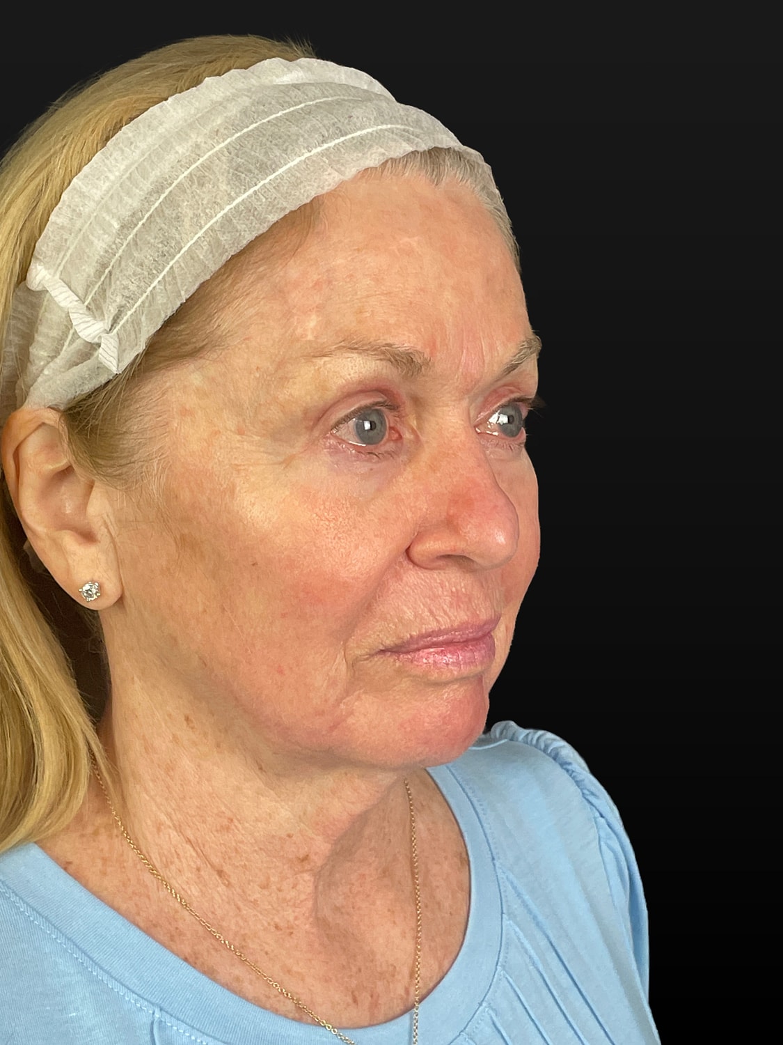 C02 Laser Resurfacing Before & After