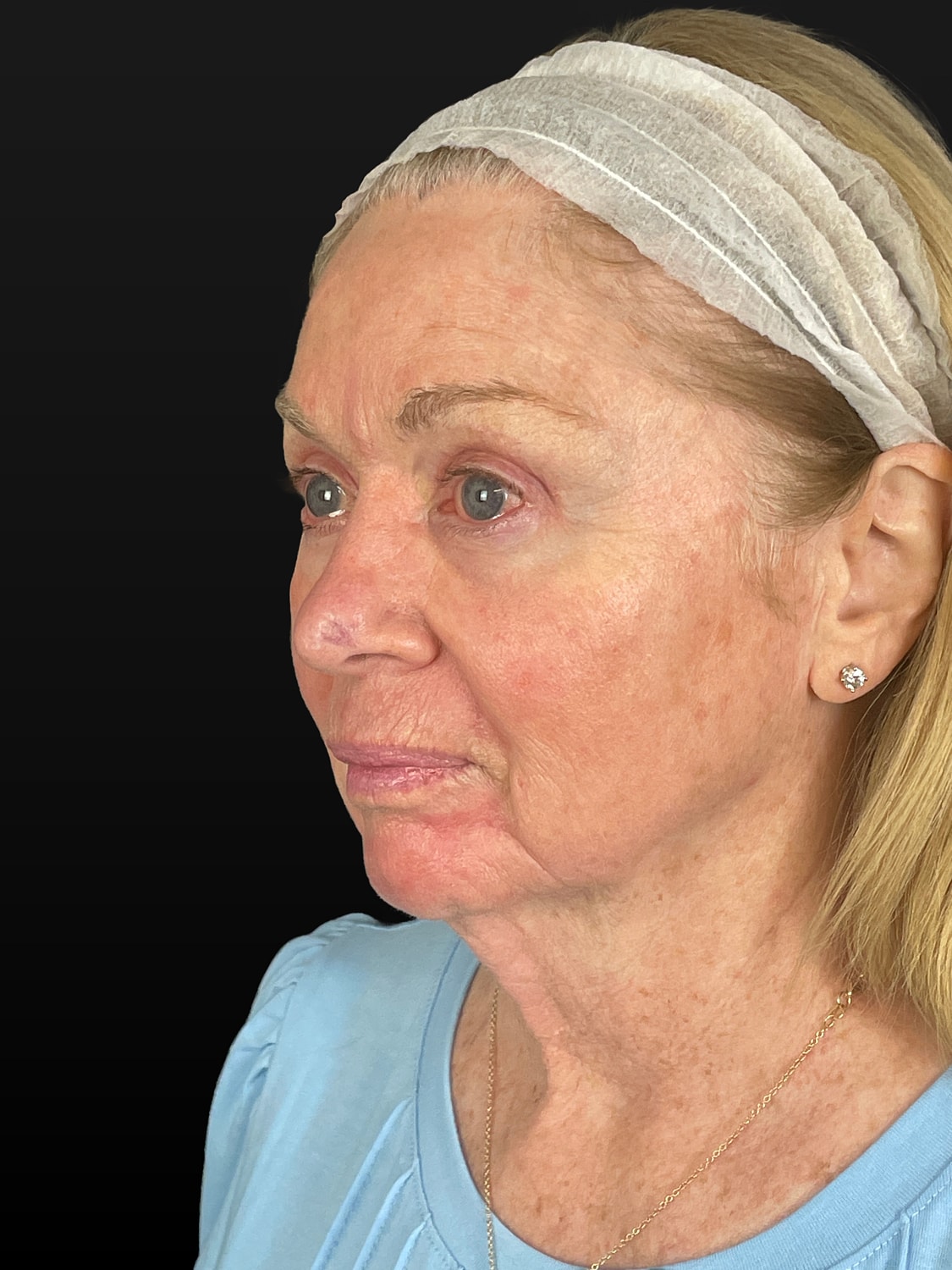 C02 Laser Resurfacing Before & After