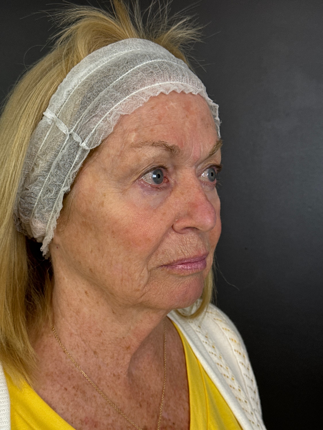 C02 Laser Resurfacing Before & After