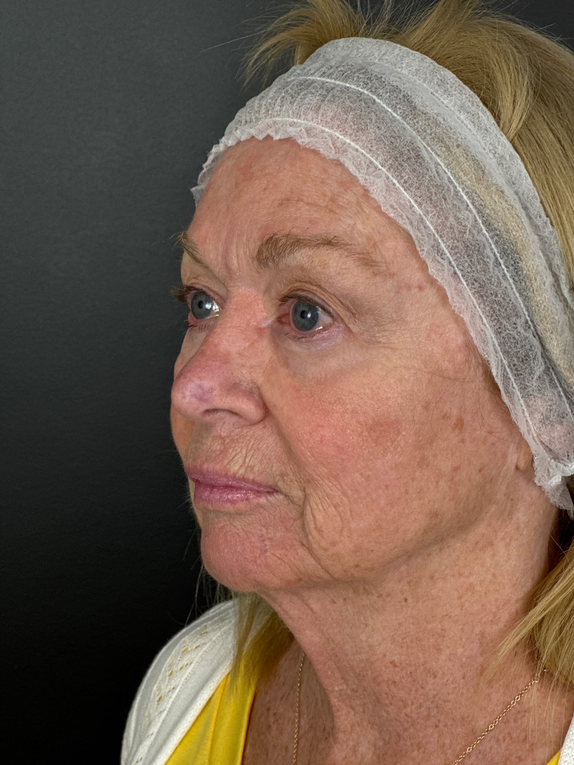 C02 Laser Resurfacing Before & After