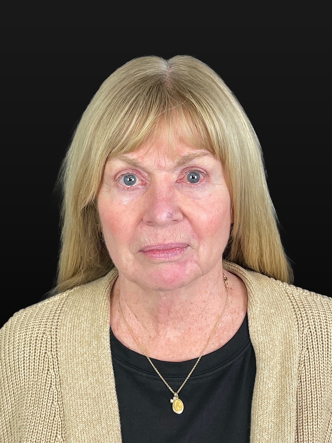 C02 Laser Resurfacing Before & After