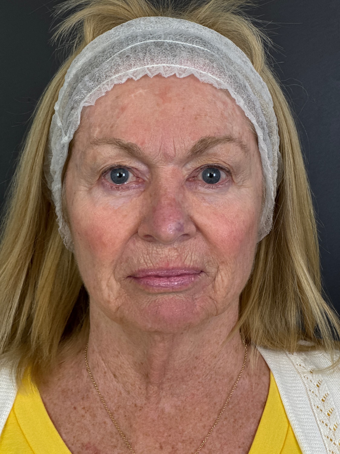 C02 Laser Resurfacing Before & After