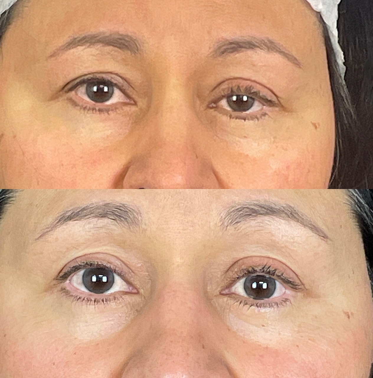 Ptosis Before & After